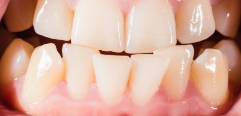 Shifting neighbouring teeth